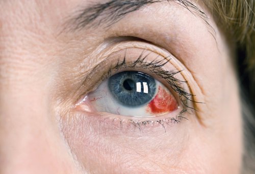 What is a Sub-conjunctival haemorrhage?